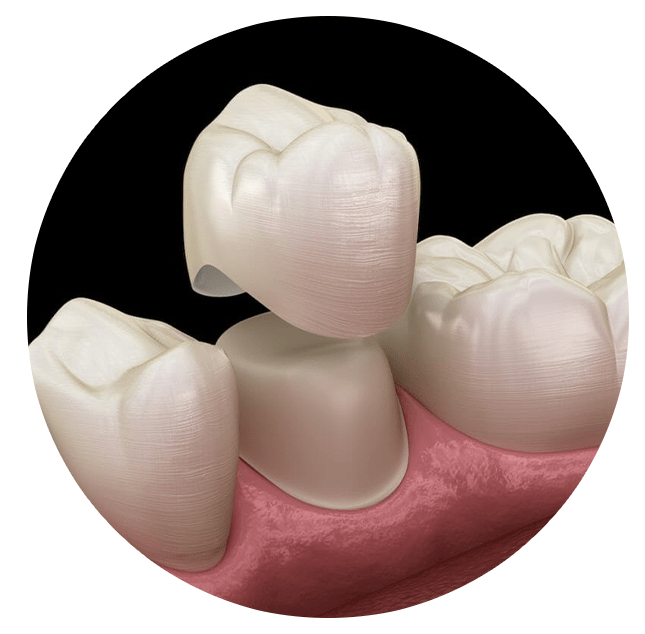 Dental crown premolar tooth assembly process