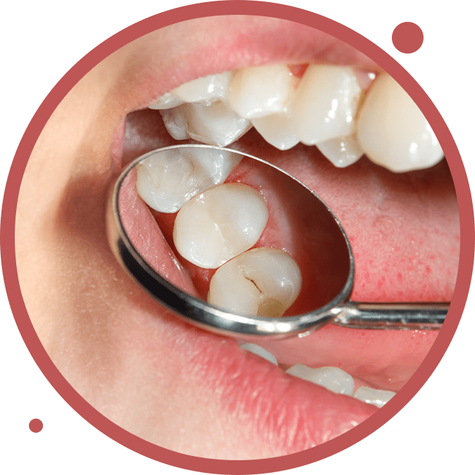 Filling with dental composite photopolymer material using rabbders